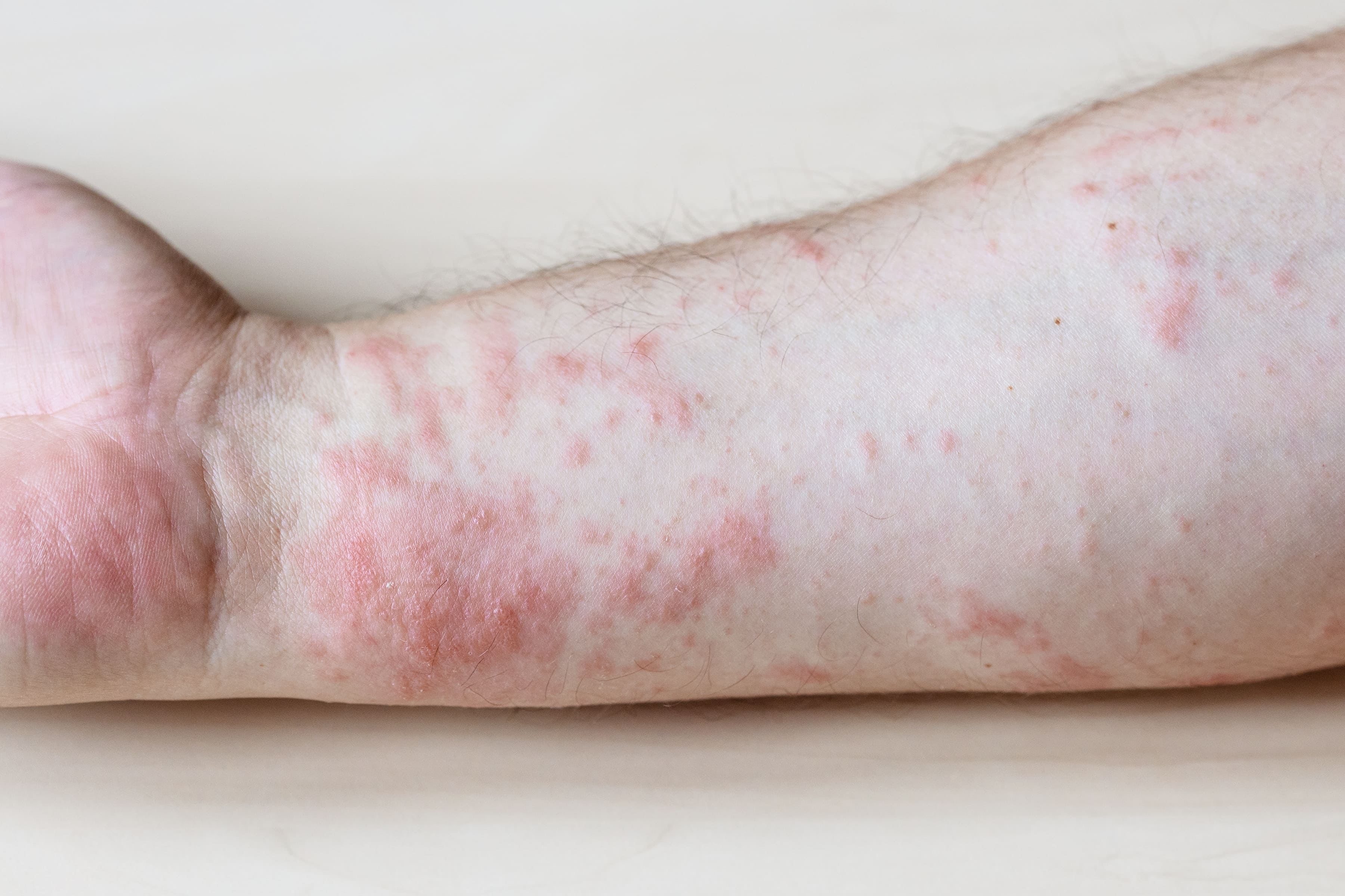 Себорейный дерматит на коже и голове - причины, симптомы, диагностика,  лечение