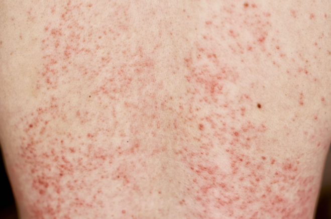 Красные пятна на теле - причины, лечение, симптомы и диагностика пятен на  коже